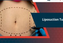 The Cost of Liposuction Surgery In Turkey