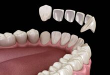 dental imperfections