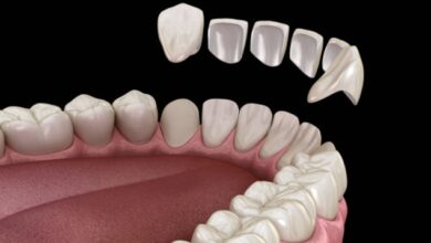 dental imperfections
