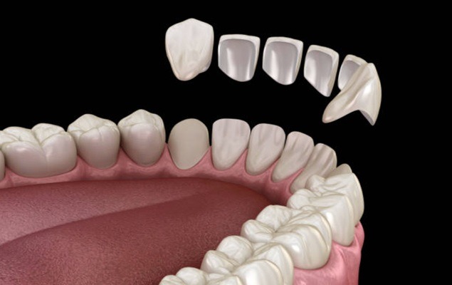 dental imperfections